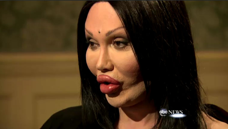Orlan Plastic Surgery