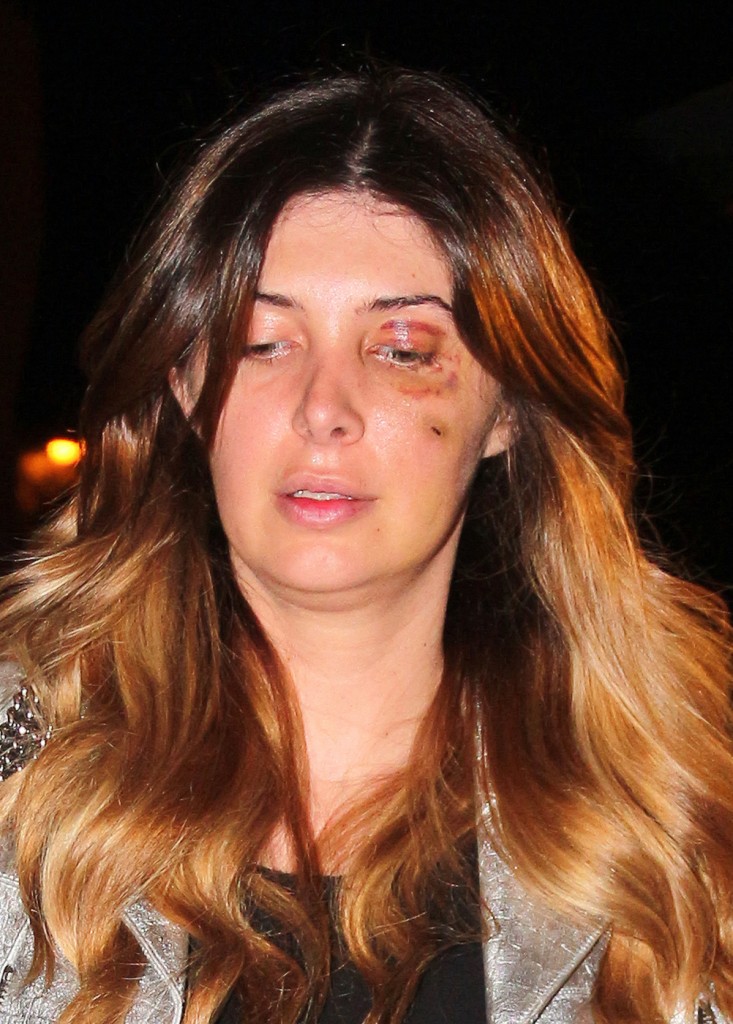 Brittny Gastineau, with black eye and stiches on the face, seen at Craig's in West Hollywood