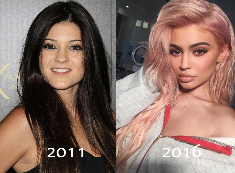 http://www.celebitchy.com/wp-content/uploads/2016/10/kyliebeforeafter2.jpg